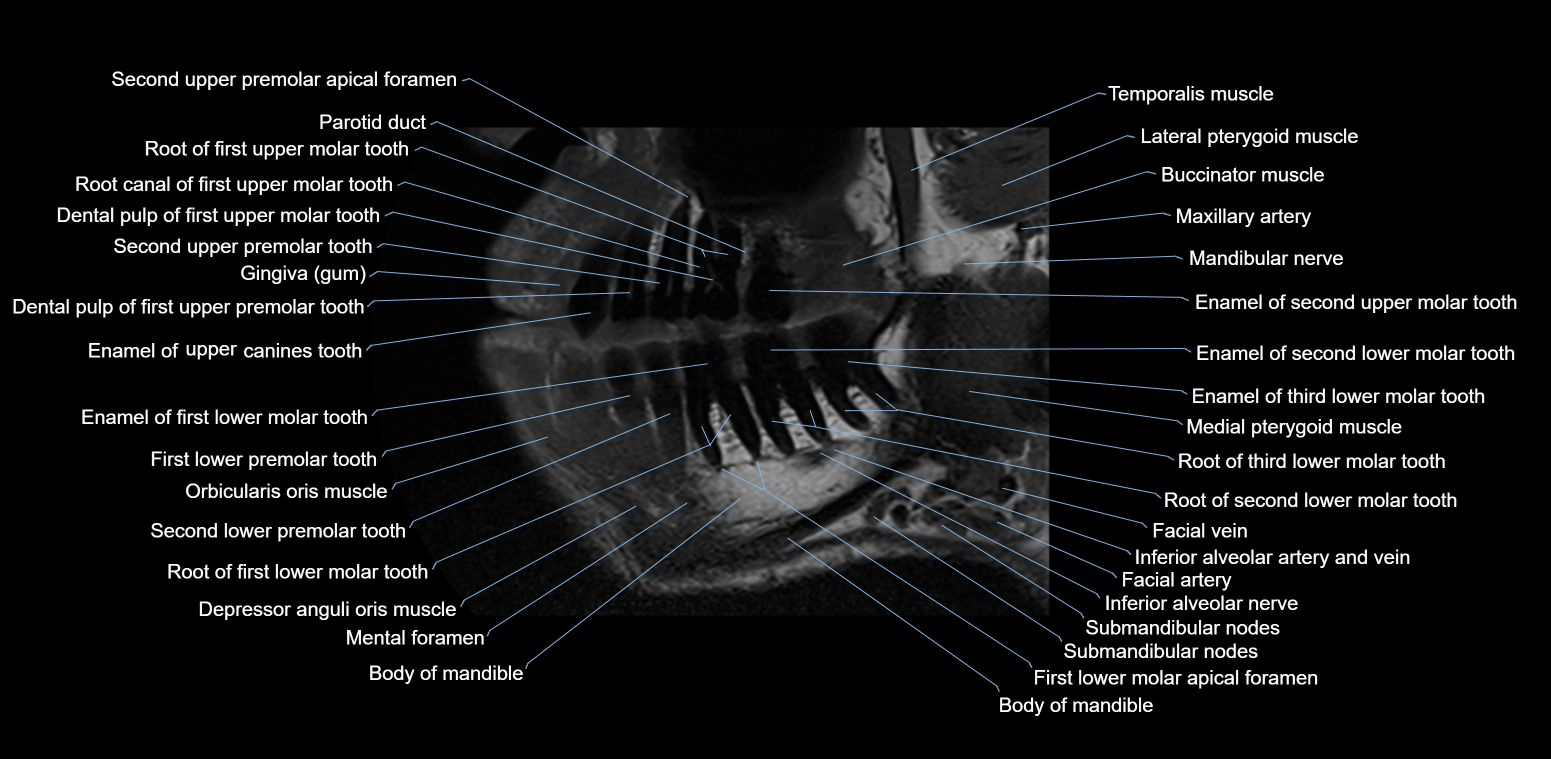 Dental MRI( tooth) sagittal labelled  cross sectional 3T anatomy -img-00001-00005.webp